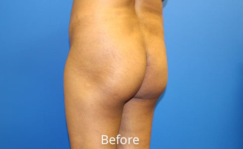 Brazilian Butt Lift Before & After Gallery - Patient 353245 - Image 5