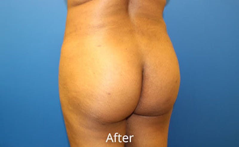 Brazilian Butt Lift Before & After Gallery - Patient 353245 - Image 6
