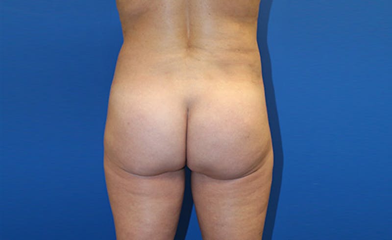 Brazilian Butt Lift Before & After Gallery - Patient 155991 - Image 2