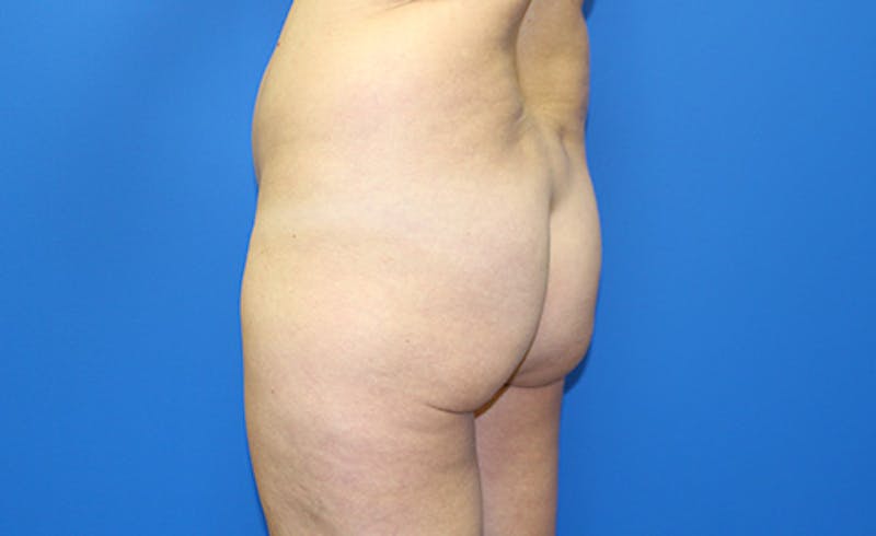 Brazilian Butt Lift Before & After Gallery - Patient 155991 - Image 3