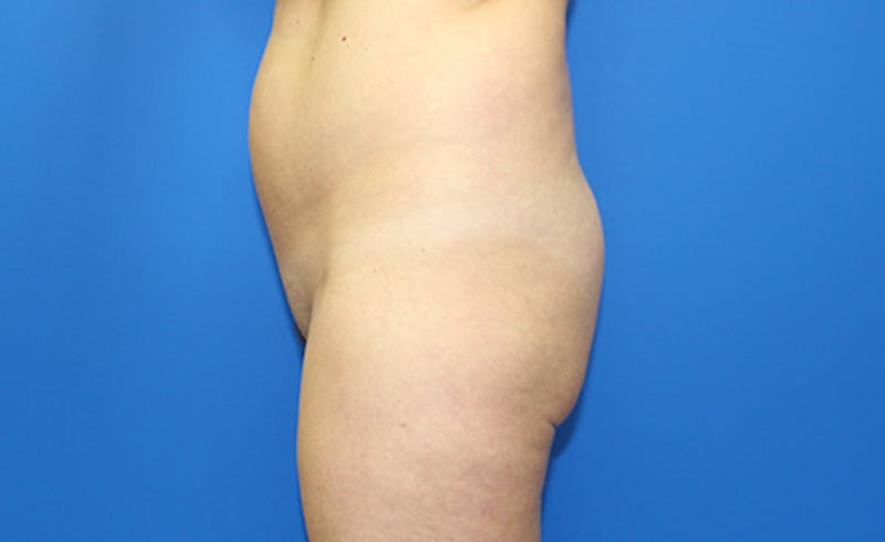 Brazilian Butt Lift Before & After Gallery - Patient 155991 - Image 5