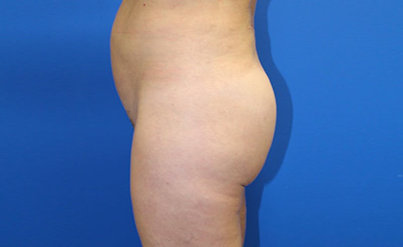 Brazilian Butt Lift Before & After Gallery - Patient 155991 - Image 6
