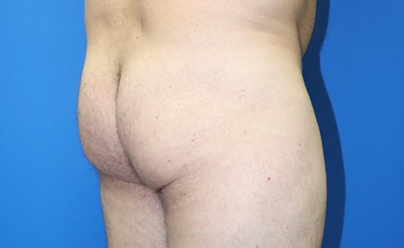 Brazilian Butt Lift Before & After Gallery - Patient 550807 - Image 1