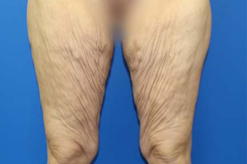 Thigh Lift Before & After Gallery - Patient 206316 - Image 1