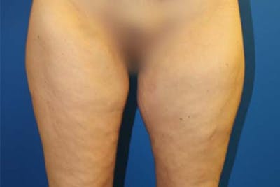 Thigh Lift Before & After Gallery - Patient 206316 - Image 2