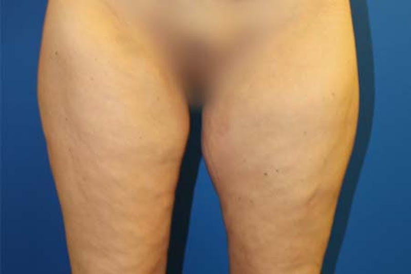 Thigh Lift Before & After Gallery - Patient 206316 - Image 2