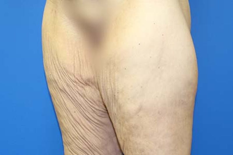 Thigh Lift Before & After Gallery - Patient 206316 - Image 3