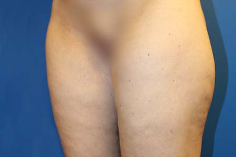 Thigh Lift Before & After Gallery - Patient 206316 - Image 4