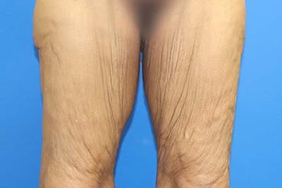 Thigh Lift Before & After Gallery - Patient 327089 - Image 1