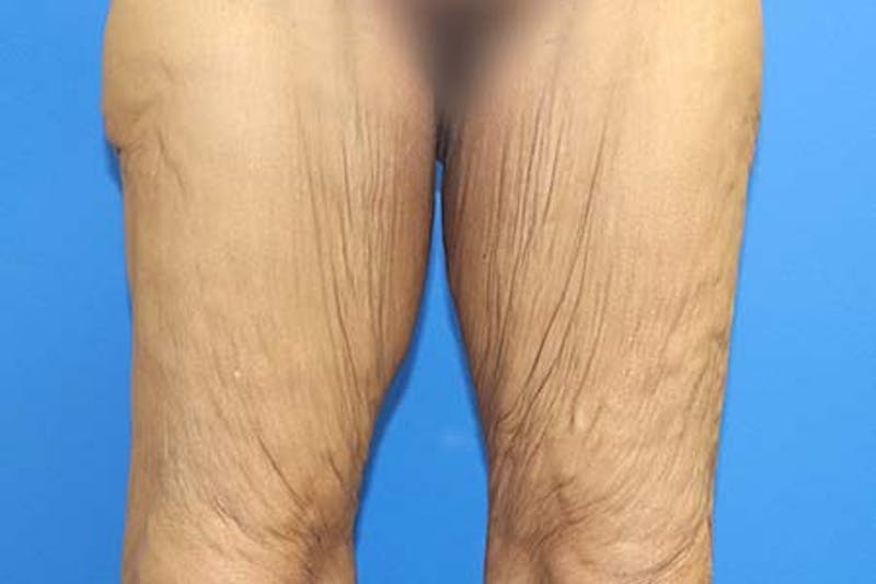 Thigh Lift Before & After Gallery - Patient 327089 - Image 1