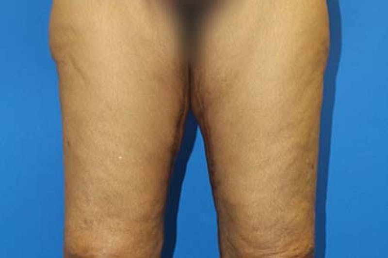 Thigh Lift Before & After Gallery - Patient 327089 - Image 2