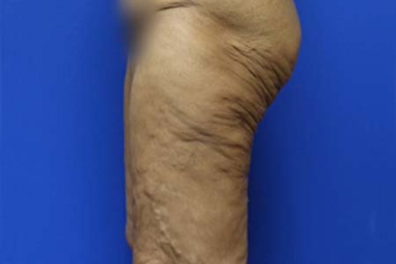 Thigh Lift Before & After Gallery - Patient 327089 - Image 3