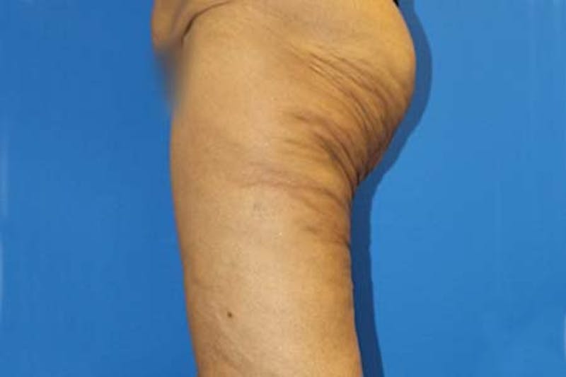 Thigh Lift Before & After Gallery - Patient 327089 - Image 4