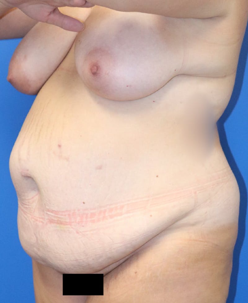 Mommy Makeover Before & After Gallery - Patient 426077 - Image 5