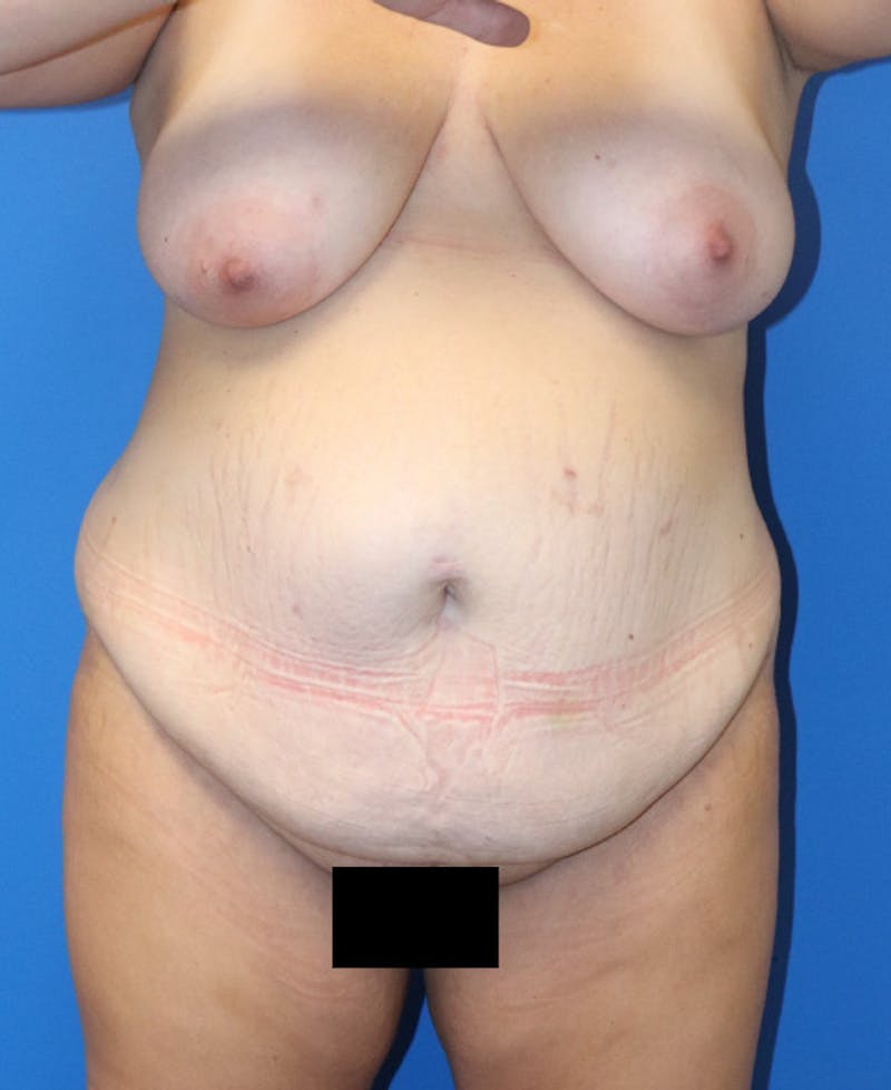 Mommy Makeover Before & After Gallery - Patient 426077 - Image 1