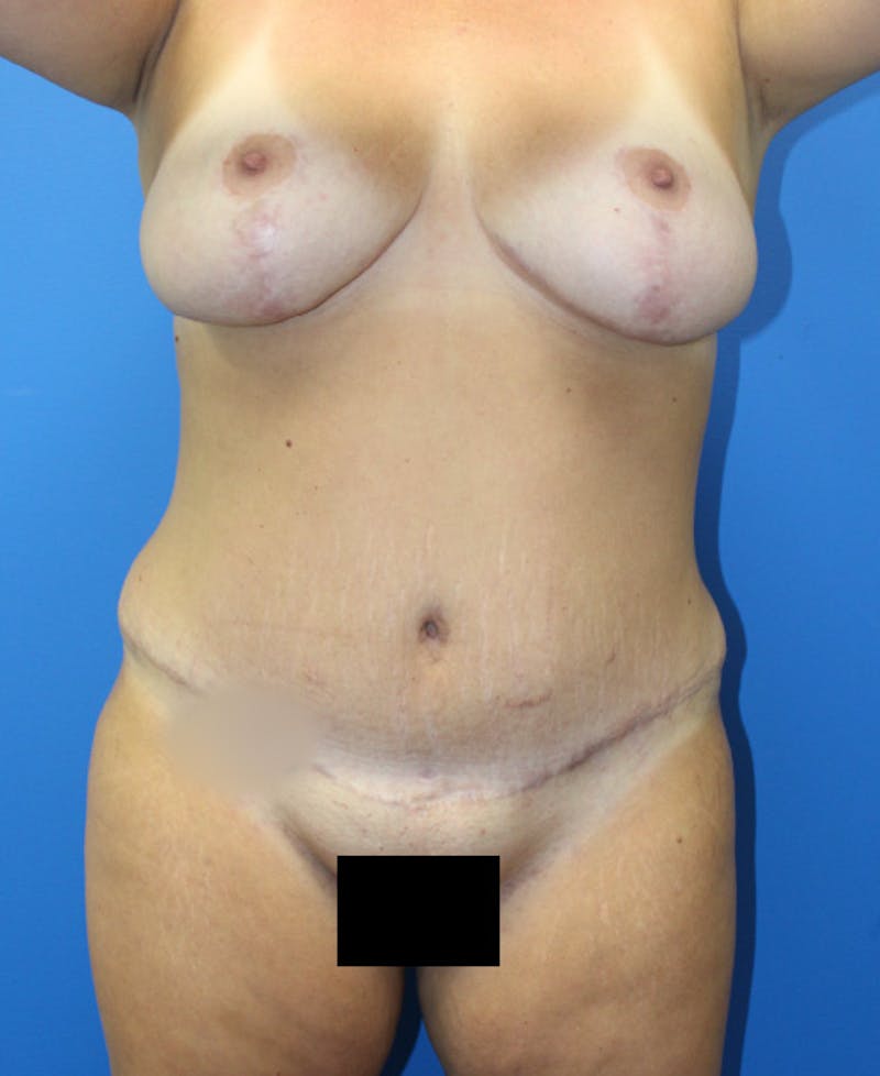 Mommy Makeover Before & After Gallery - Patient 426077 - Image 2