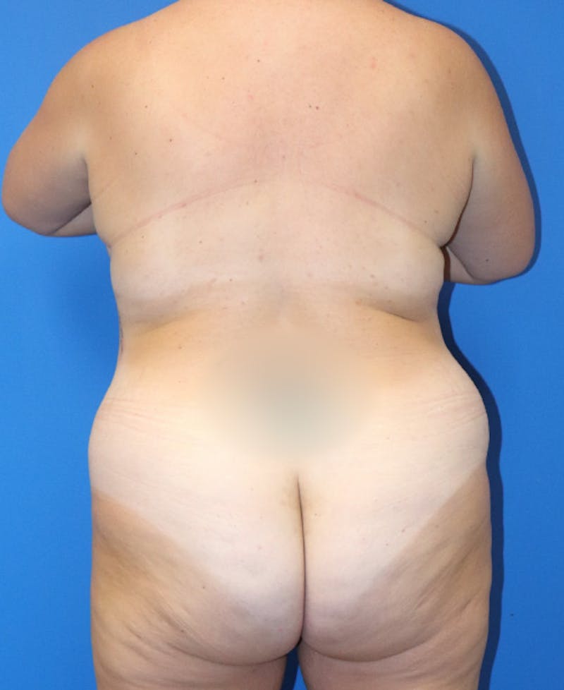 Mommy Makeover Before & After Gallery - Patient 426077 - Image 7