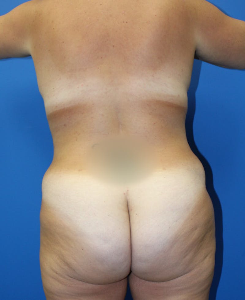 Mommy Makeover Before & After Gallery - Patient 426077 - Image 8