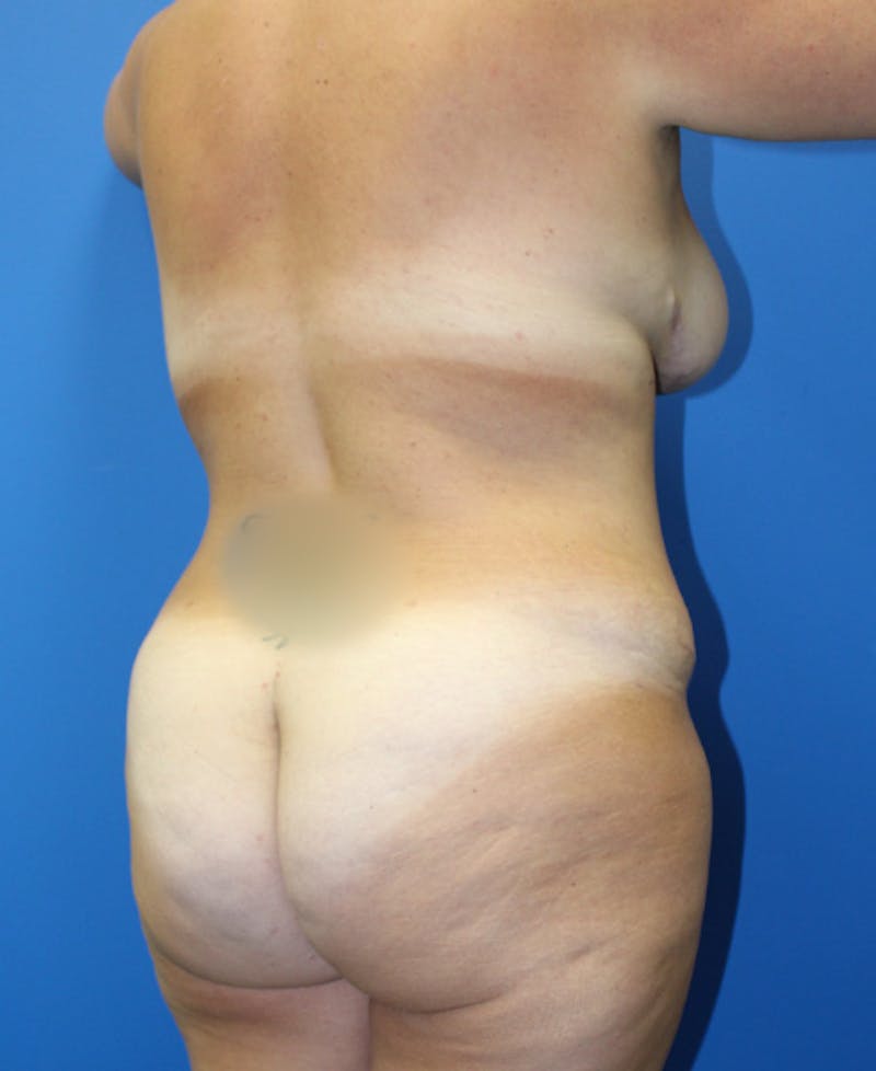 Mommy Makeover Before & After Gallery - Patient 426077 - Image 10