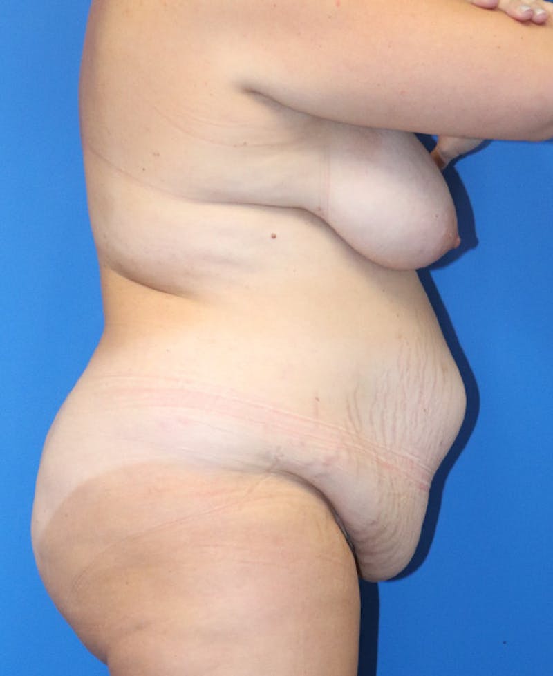 Mommy Makeover Before & After Gallery - Patient 426077 - Image 11