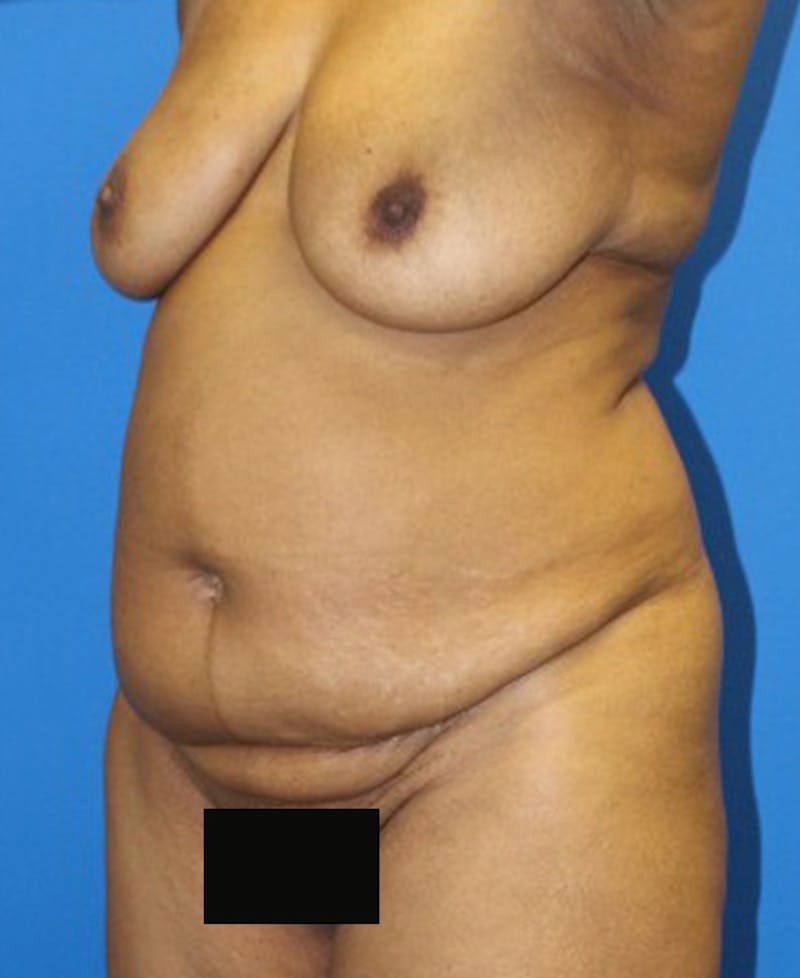 Mommy Makeover Before & After Gallery - Patient 158073 - Image 3