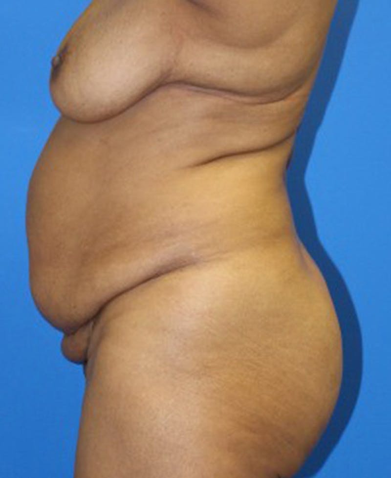 Mommy Makeover Before & After Gallery - Patient 158073 - Image 5