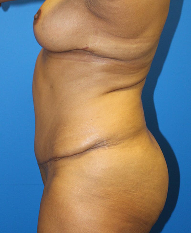 Mommy Makeover Before & After Gallery - Patient 158073 - Image 6