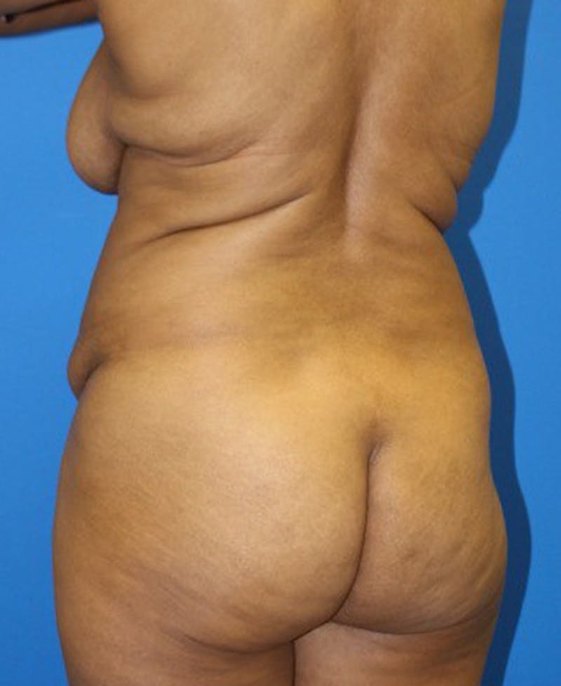Mommy Makeover Before & After Gallery - Patient 158073 - Image 7