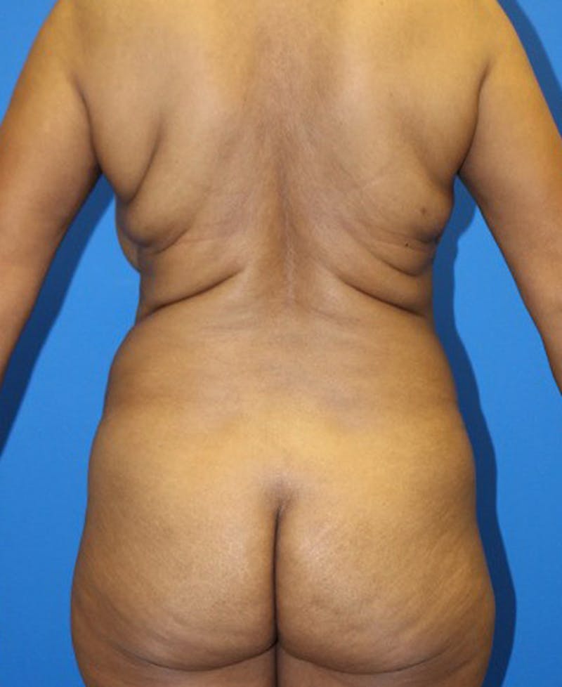 Mommy Makeover Before & After Gallery - Patient 158073 - Image 9