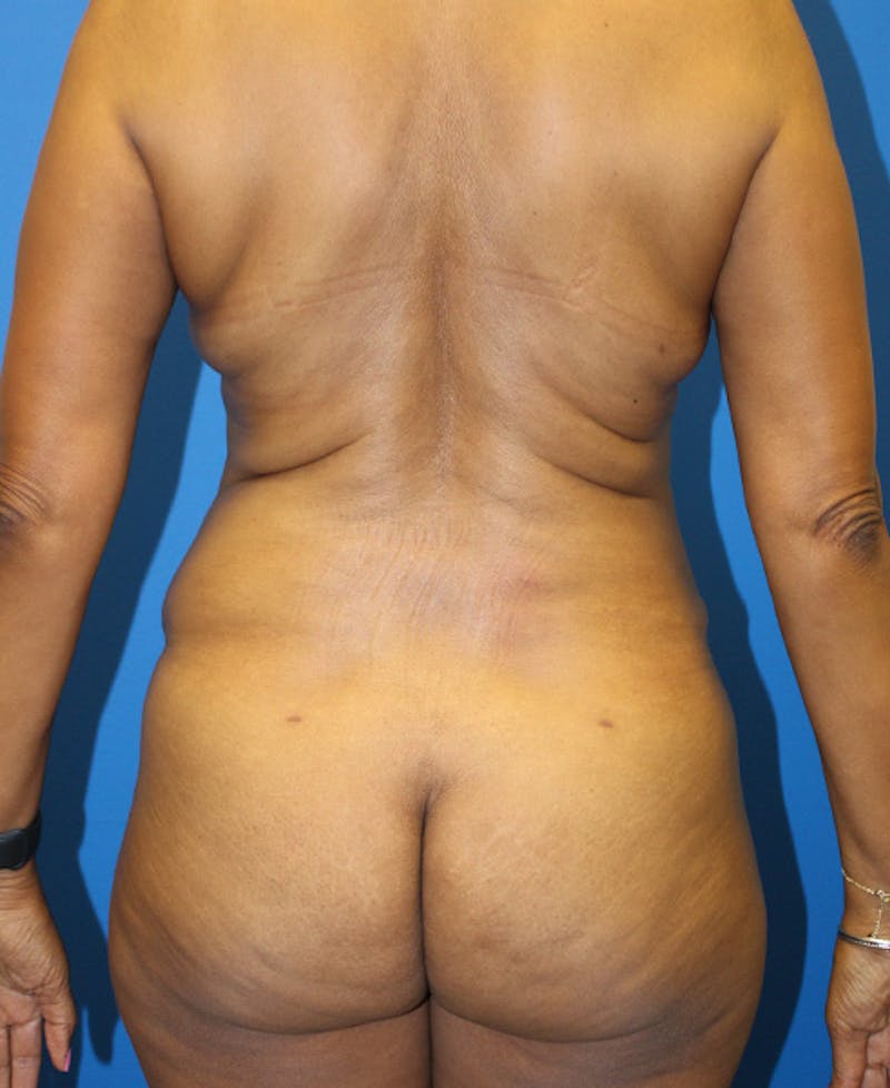 Mommy Makeover Before & After Gallery - Patient 158073 - Image 10