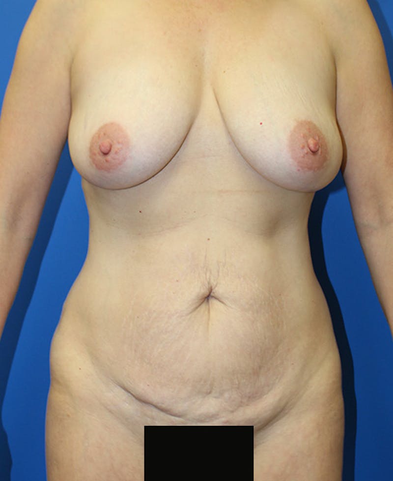 Mommy Makeover Before & After Gallery - Patient 360008 - Image 1