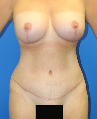 Mommy Makeover Before & After Gallery - Patient 360008 - Image 2