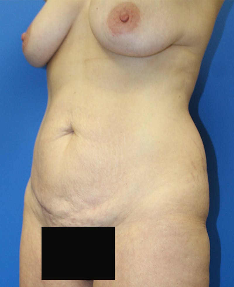 Mommy Makeover Before & After Gallery - Patient 360008 - Image 3