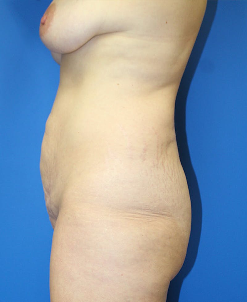 Mommy Makeover Before & After Gallery - Patient 360008 - Image 5