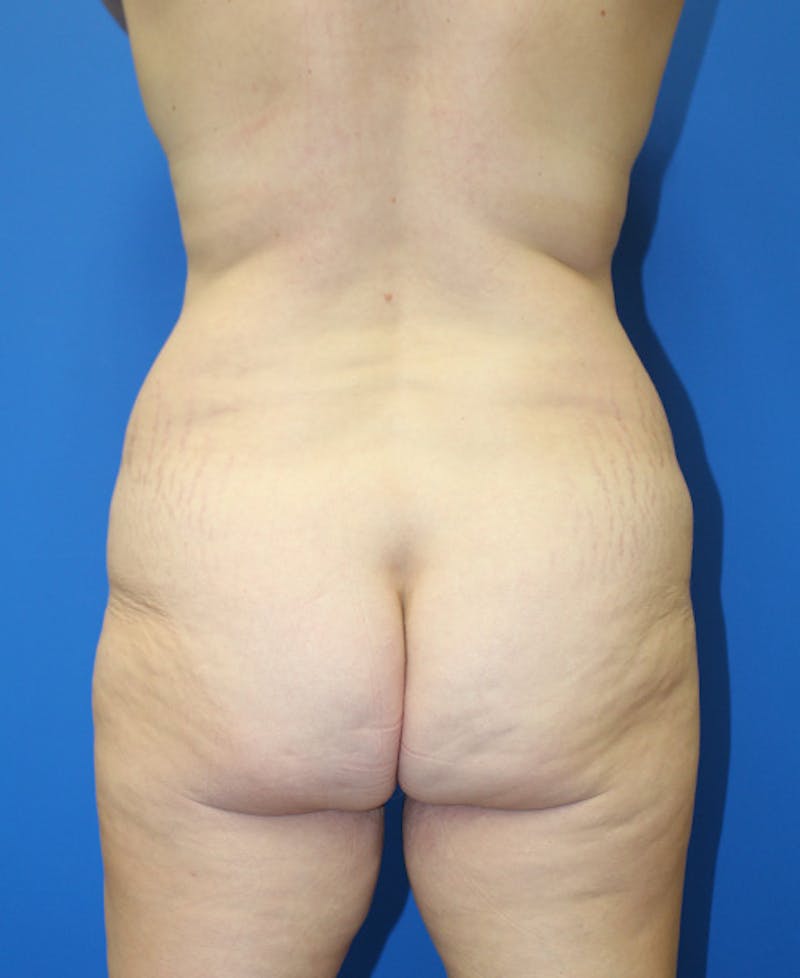 Mommy Makeover Before & After Gallery - Patient 360008 - Image 9