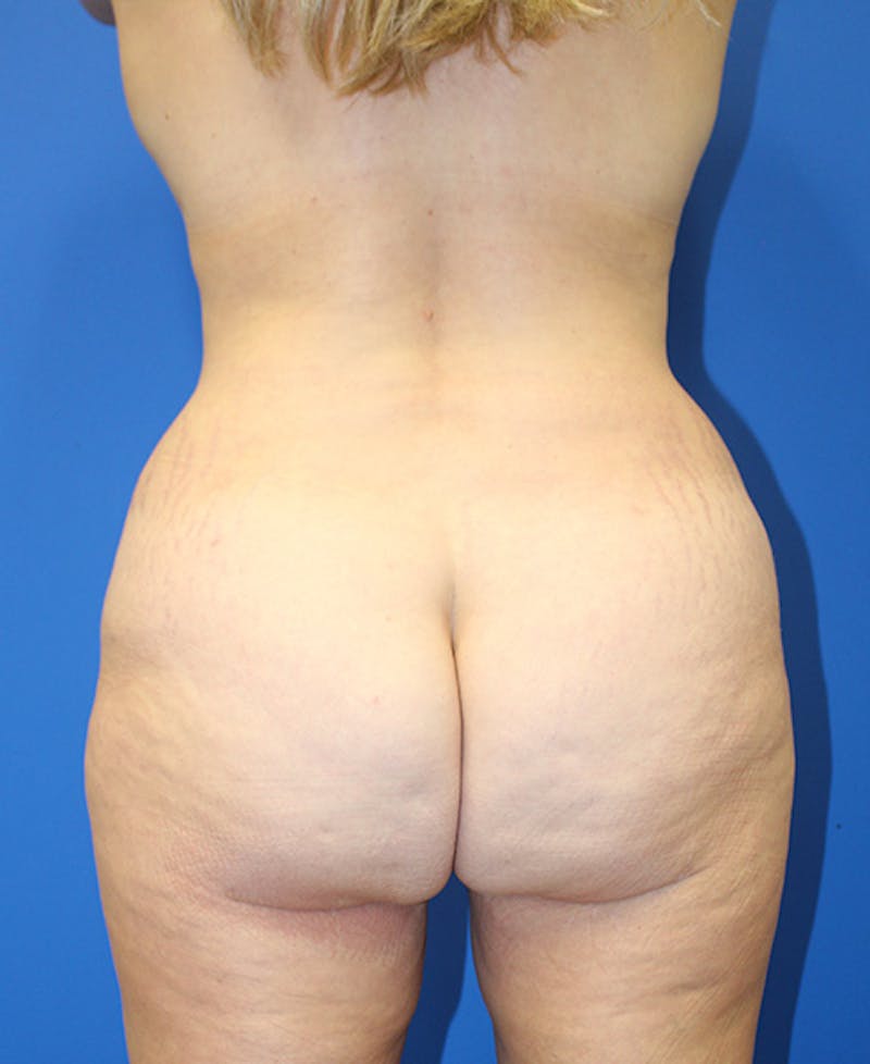 Mommy Makeover Before & After Gallery - Patient 360008 - Image 10