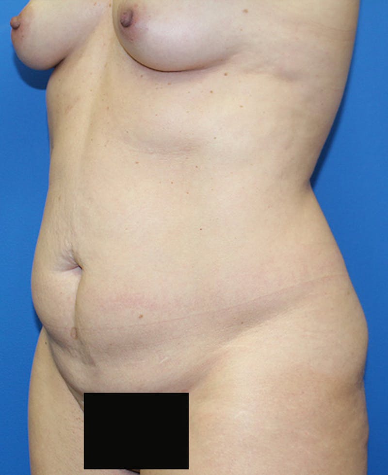 Mommy Makeover Before & After Gallery - Patient 139467 - Image 3