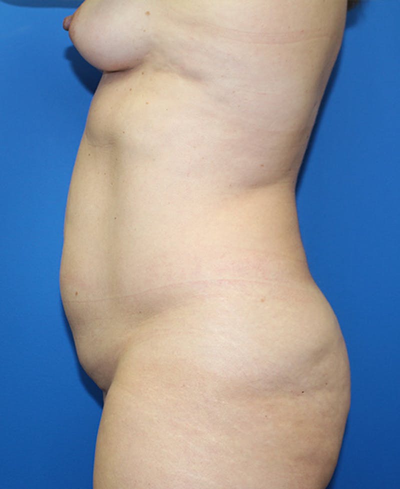 Mommy Makeover Before & After Gallery - Patient 139467 - Image 5