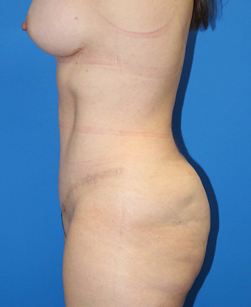 Mommy Makeover Before & After Gallery - Patient 139467 - Image 6