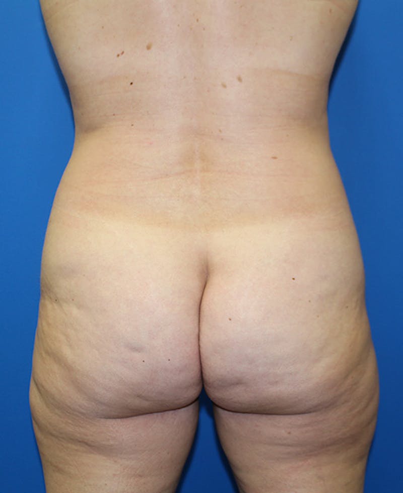 Mommy Makeover Before & After Gallery - Patient 139467 - Image 7