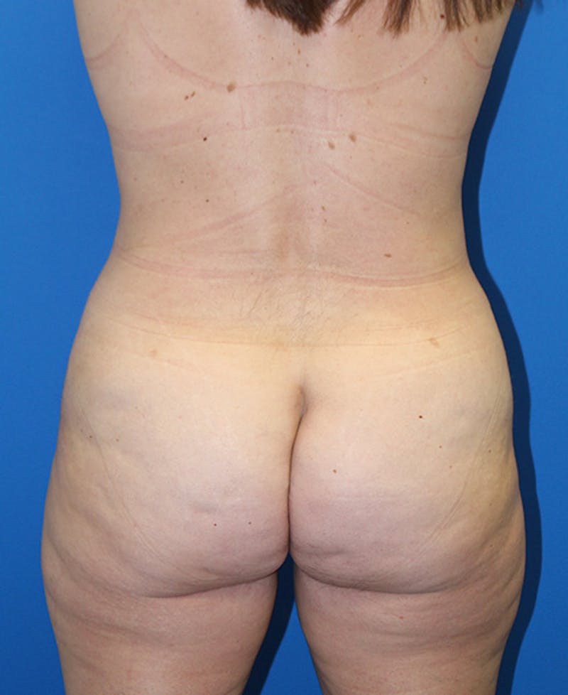 Mommy Makeover Before & After Gallery - Patient 139467 - Image 8
