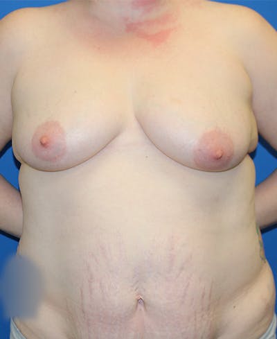 Mommy Makeover Before & After Gallery - Patient 167477 - Image 1