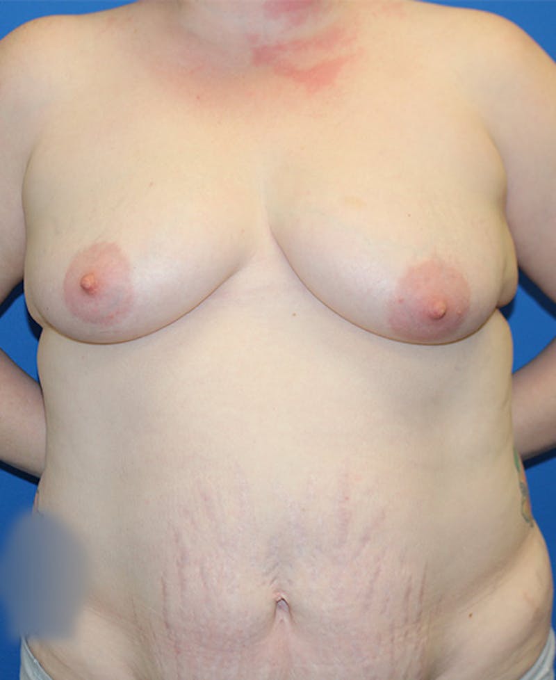 Mommy Makeover Before & After Gallery - Patient 167477 - Image 1
