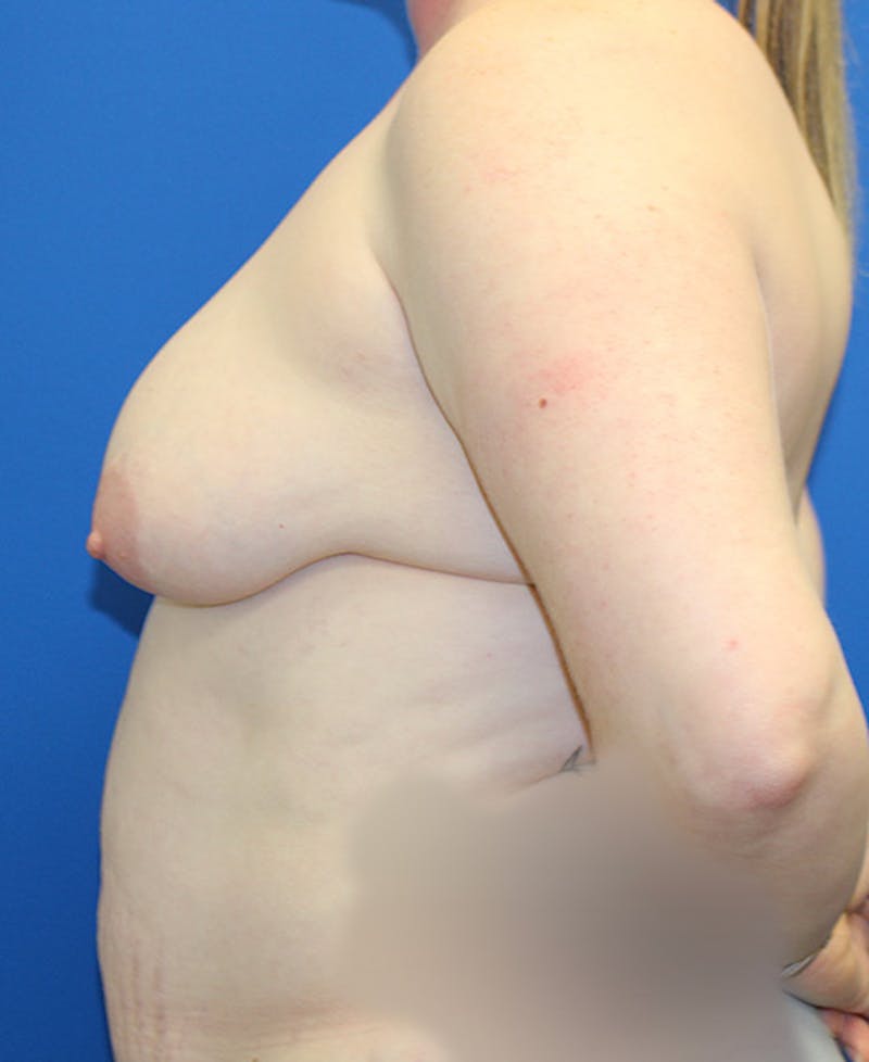 Mommy Makeover Before & After Gallery - Patient 167477 - Image 5