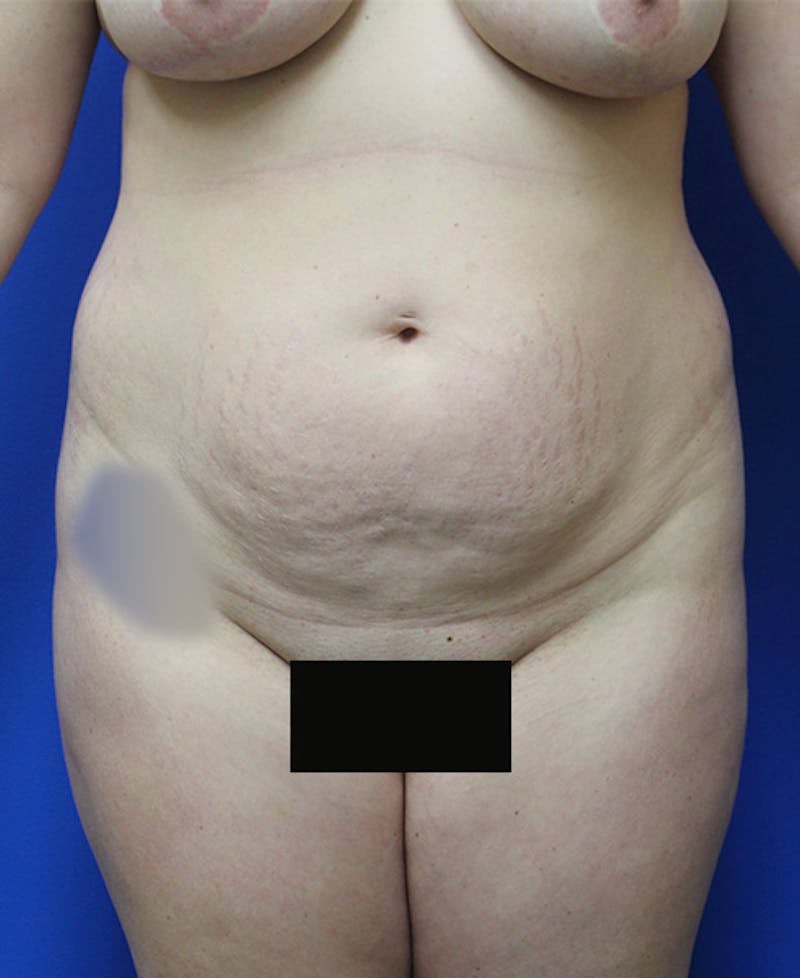 Mommy Makeover Before & After Gallery - Patient 315911 - Image 1