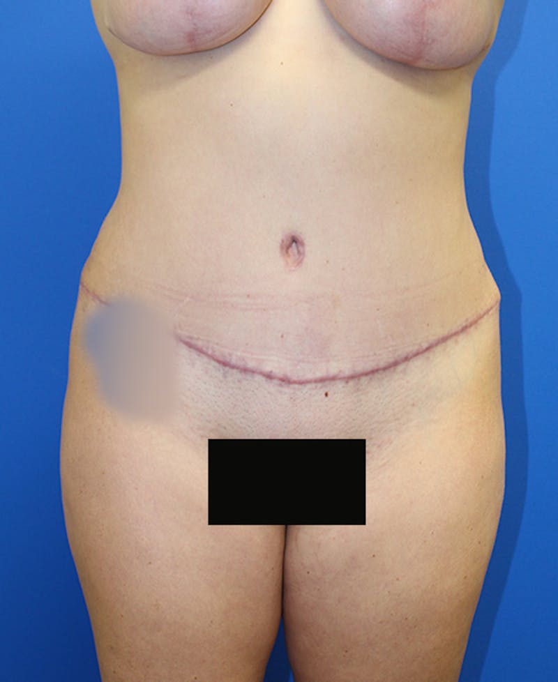 Mommy Makeover Before & After Gallery - Patient 315911 - Image 2