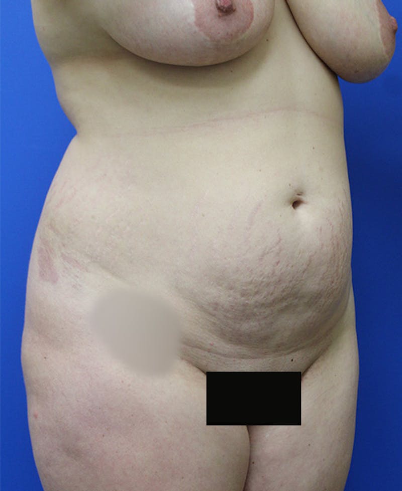 Mommy Makeover Before & After Gallery - Patient 315911 - Image 3