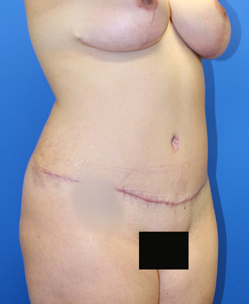 Mommy Makeover Before & After Gallery - Patient 315911 - Image 4