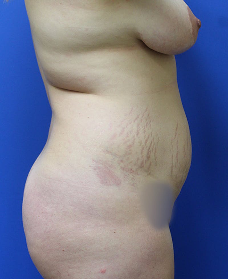 Mommy Makeover Before & After Gallery - Patient 315911 - Image 5