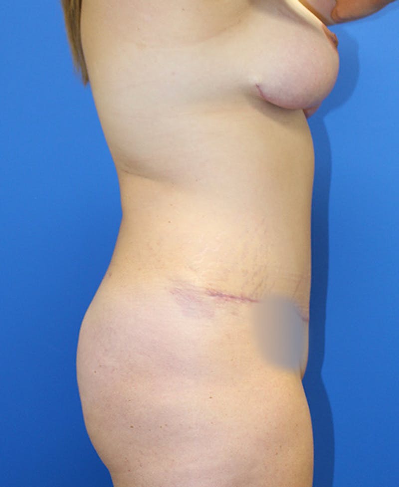 Mommy Makeover Before & After Gallery - Patient 315911 - Image 6